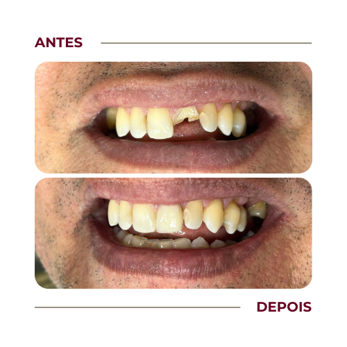 Tratamento de canal / Colocação de pino e coroa em resina