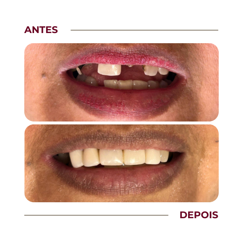 Reconstrução de dentes / Tratamento de canal