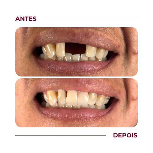 Prótese dentária